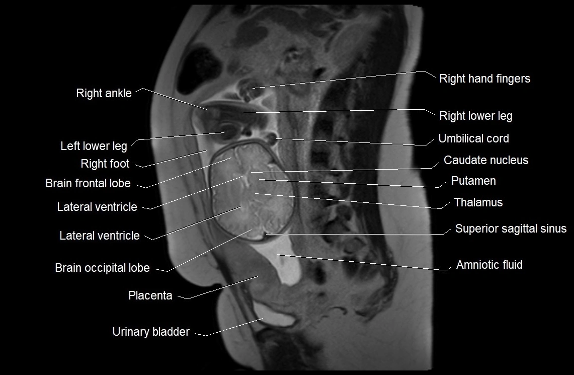 MRI fetal anatomy sagittal image 22.webp